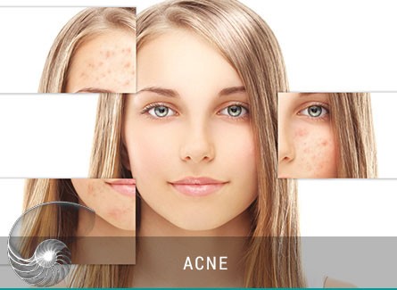 Acne